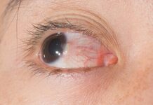 The Cost and Benefits of Intravitreal Eye Injections and Pterygium Surgery in Hervey Bay, Australia